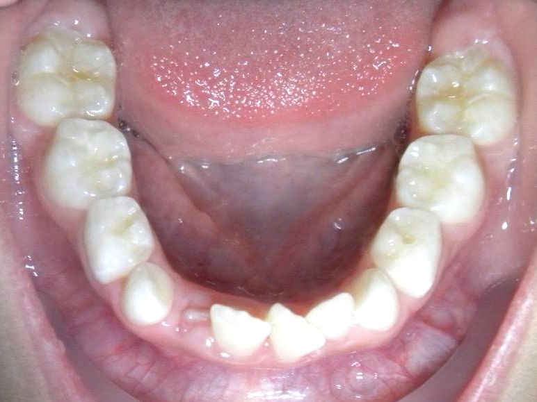 Oclusal Inferior