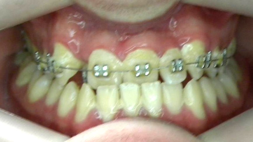 Frontal (Oclusión)