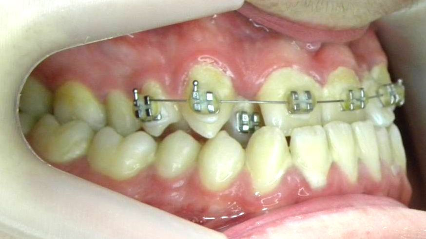 Lateral Derecha
