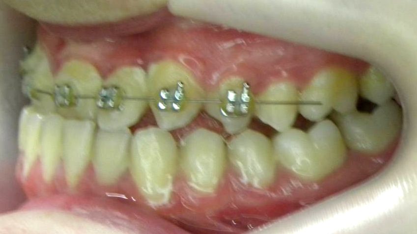 Lateral Izquierda