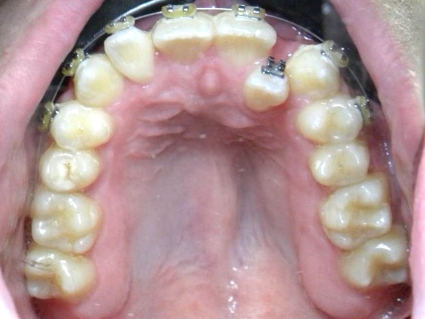 Oclusal Superior