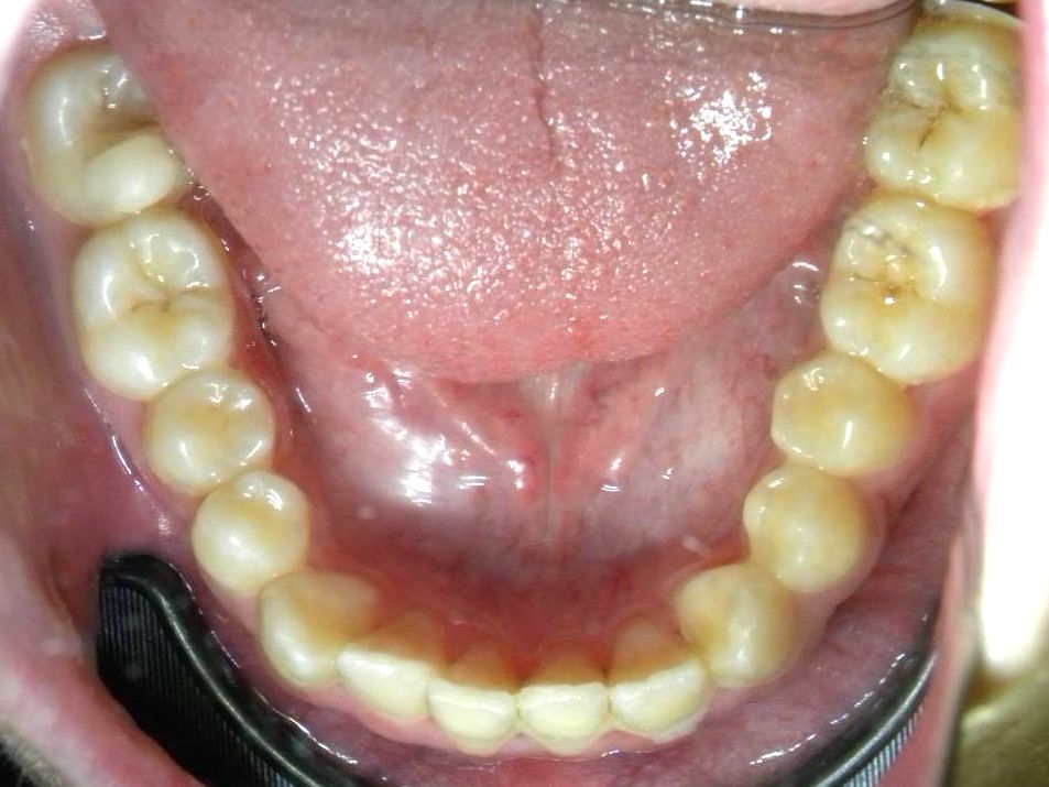 Oclusal Inferior