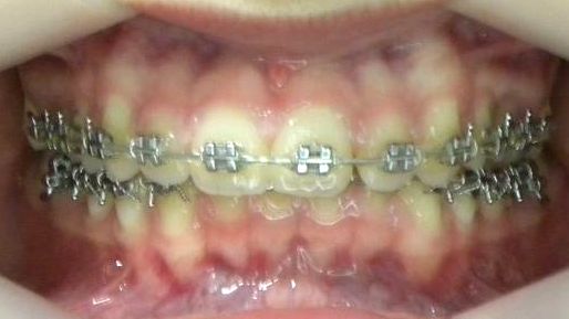 Frontal (Oclusión)