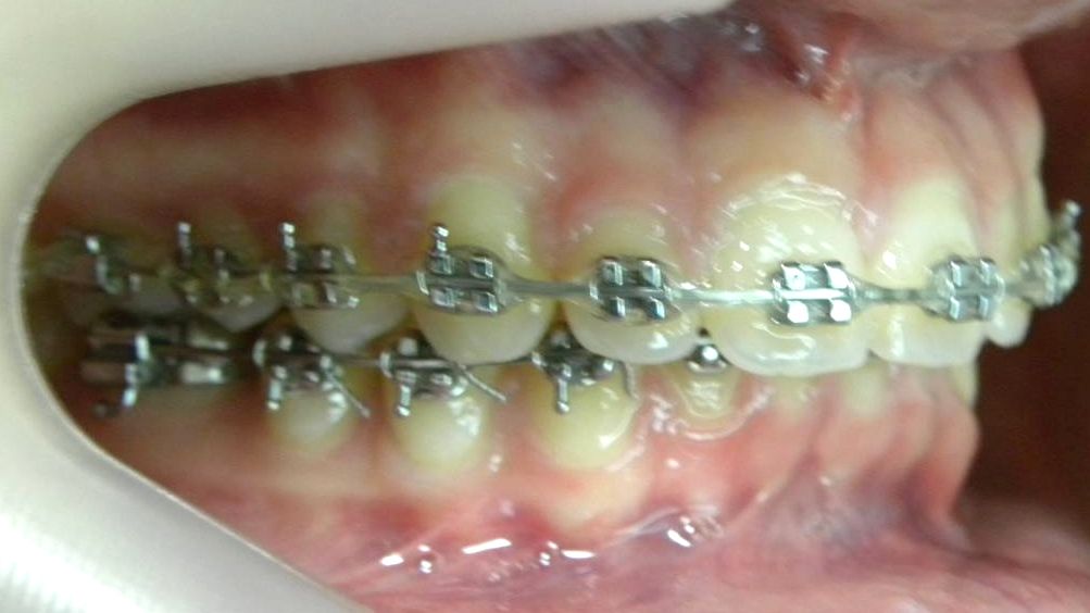 Lateral Derecha