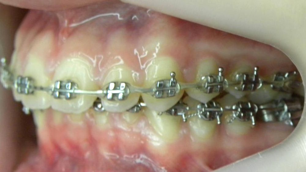 Lateral Izquierda
