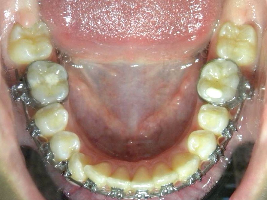 Oclusal Superior