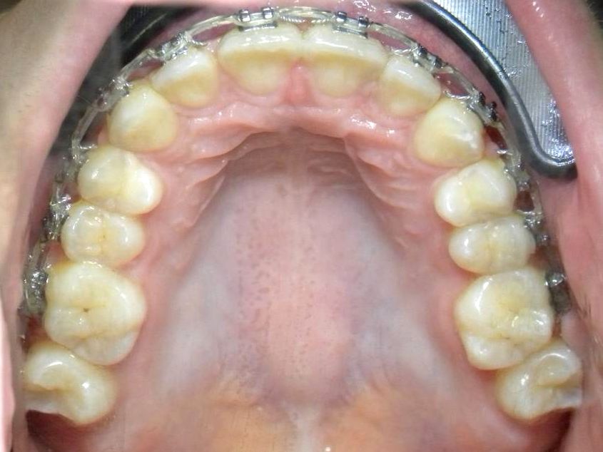 Oclusal Inferior