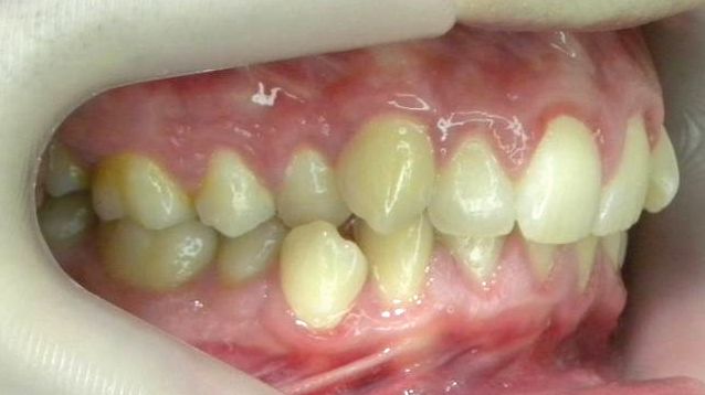 Lateral Derecha