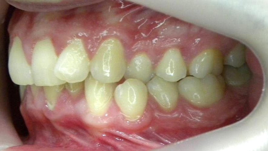 Lateral Izquierda