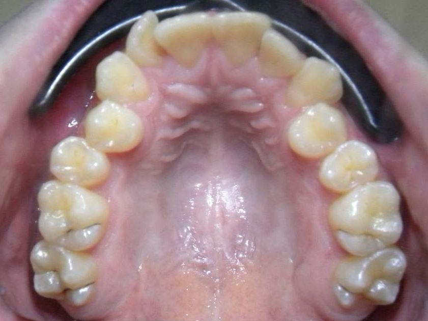 Oclusal Superior