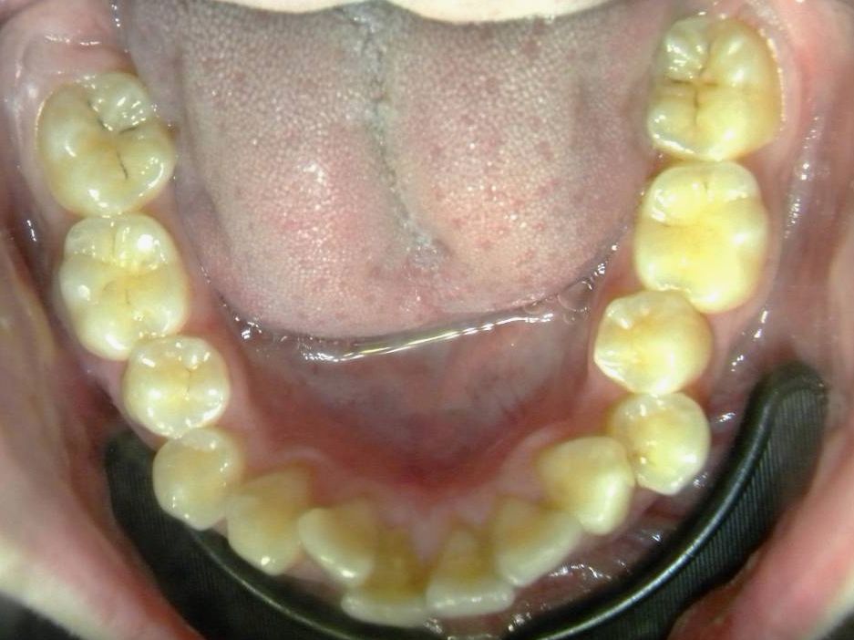 Oclusal Inferior