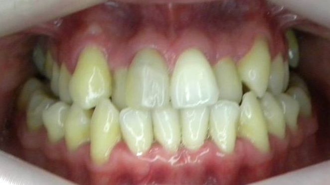 Frontal (Oclusión)