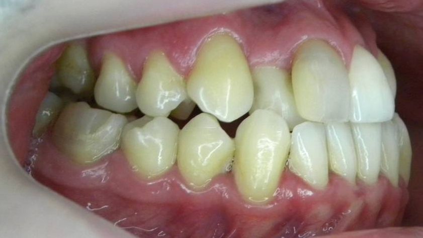 Lateral Derecha