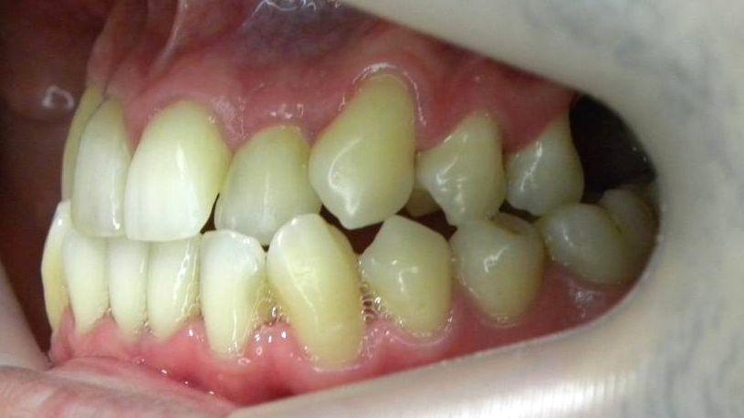 Lateral Izquierda