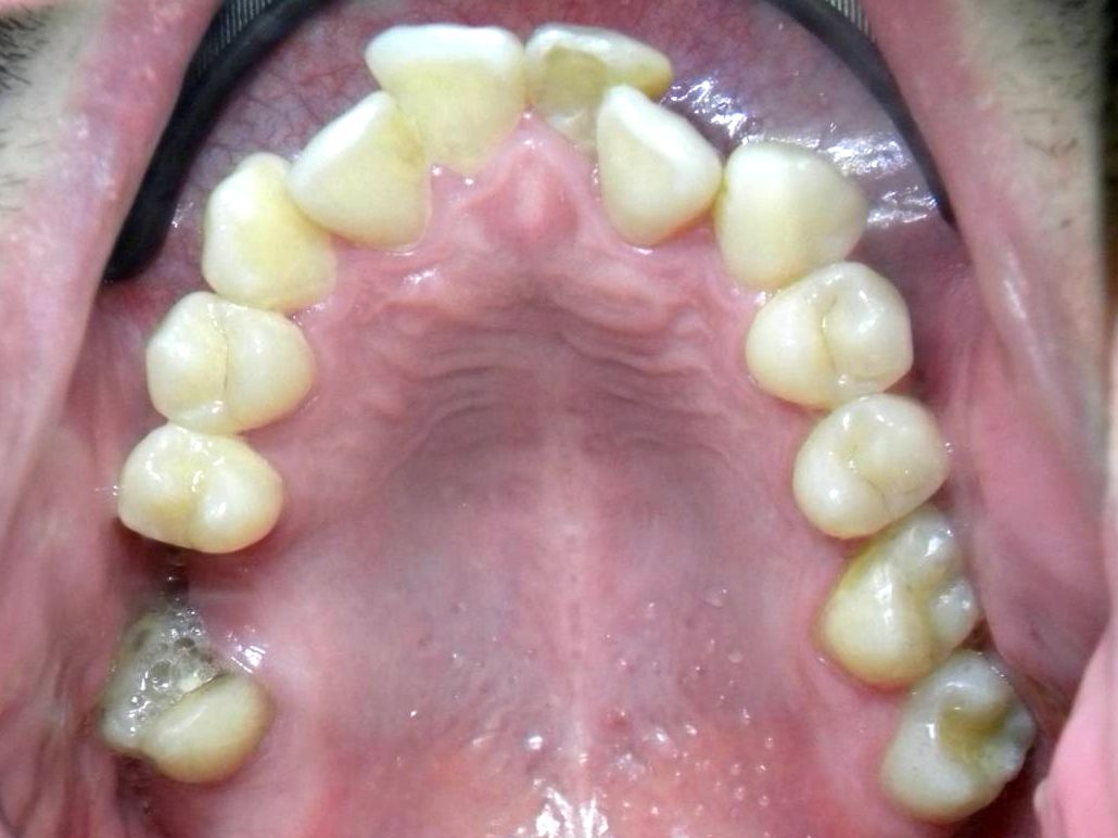 Oclusal Superior