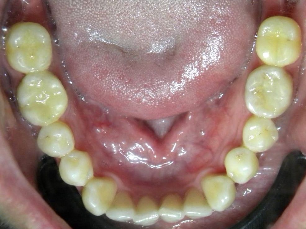 Oclusal Inferior