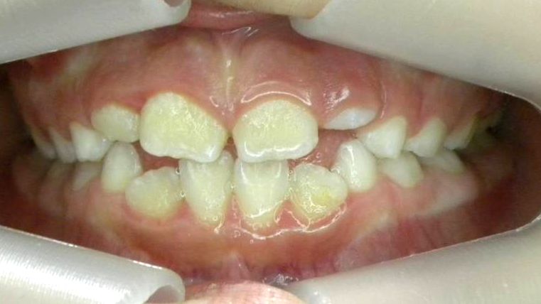 Frontal (Oclusión)