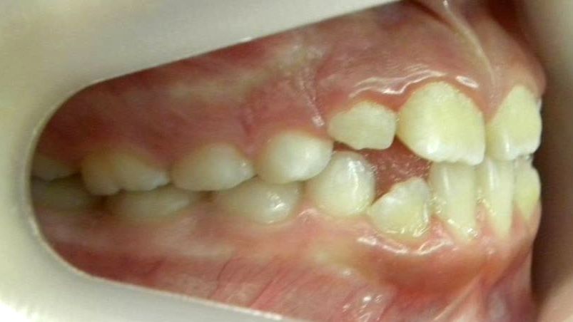 Lateral Derecha