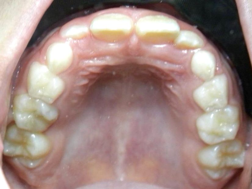 Oclusal Superior
