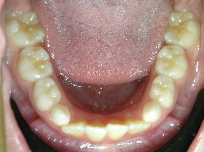 Oclusal Inferior