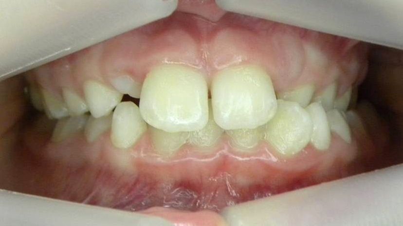 Frontal (Oclusión)