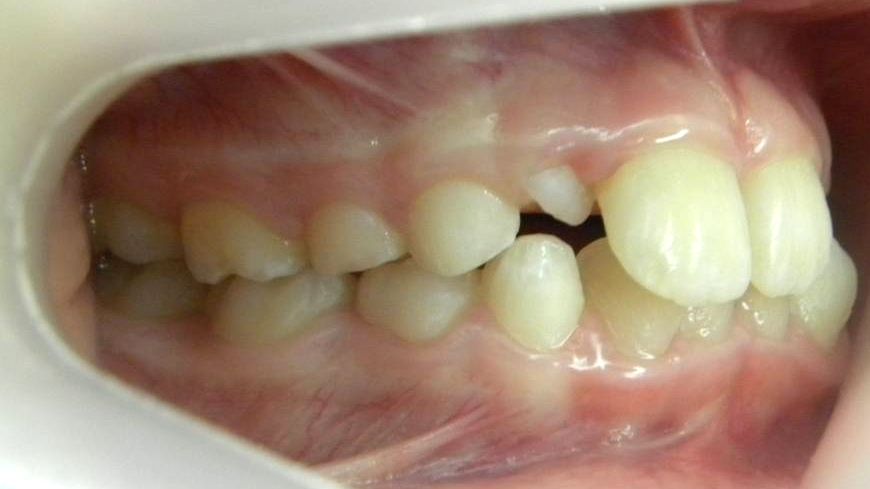 Lateral Derecha