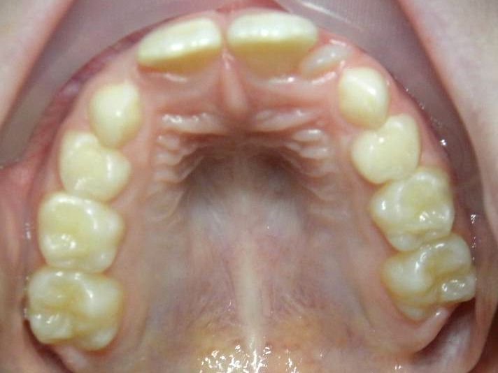 Oclusal Superior