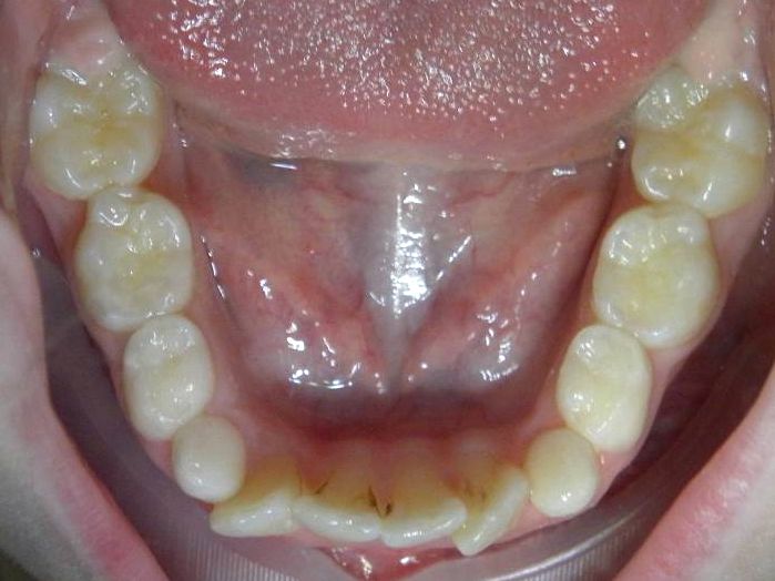 Oclusal Inferior