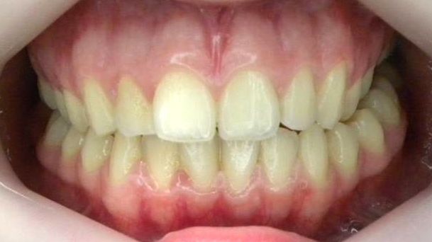 Frontal (Oclusión)