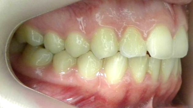 Lateral Derecha