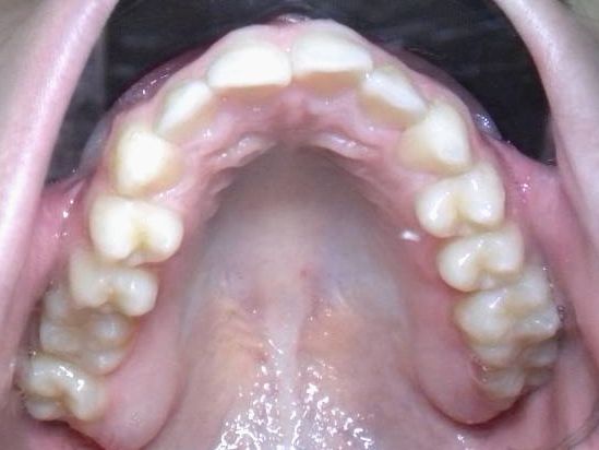 Oclusal Superior