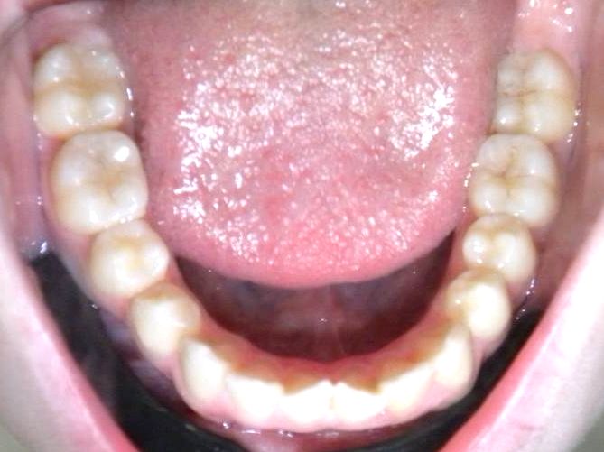 Oclusal Inferior