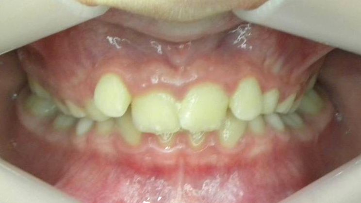 Frontal (Oclusión)
