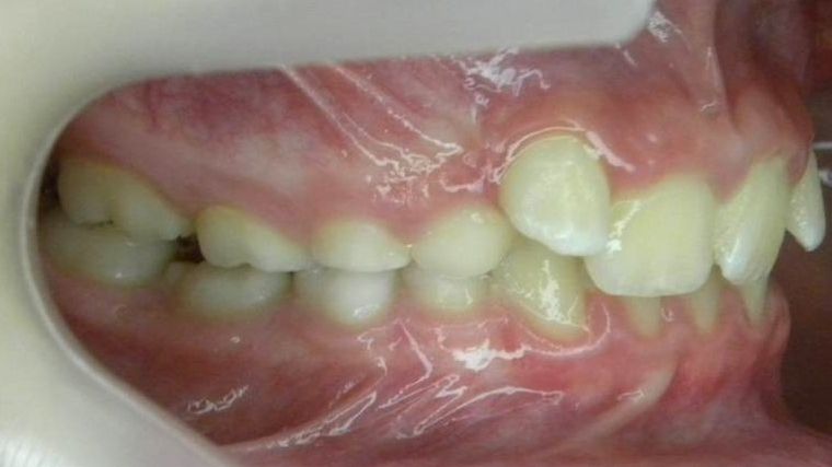 Lateral Derecha