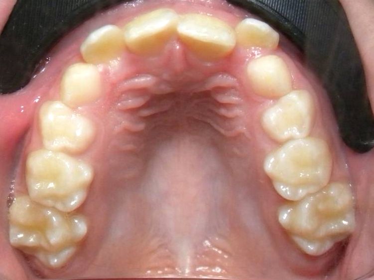 Oclusal Superior