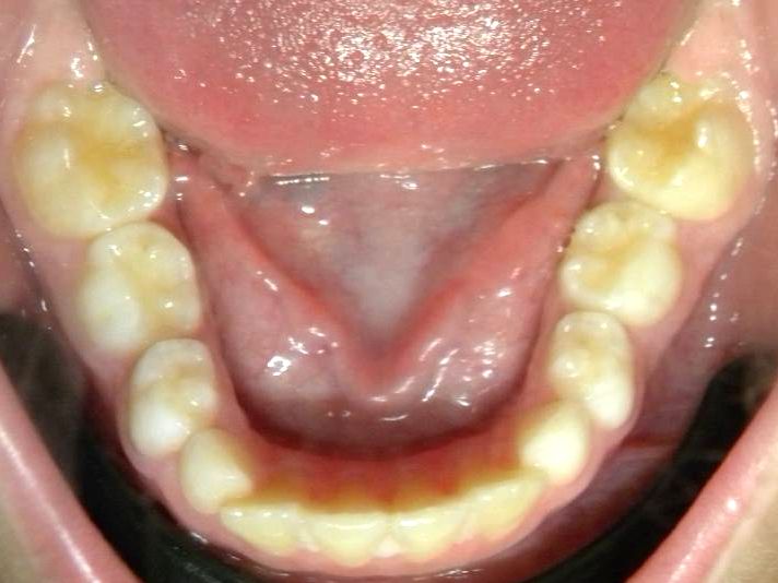 Oclusal Inferior