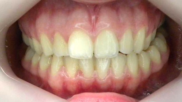 Frontal (Oclusión)