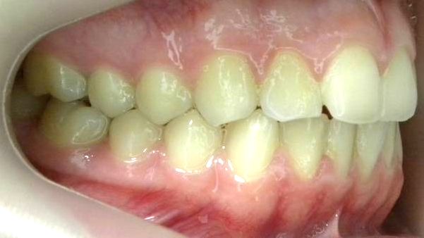 Lateral Derecha