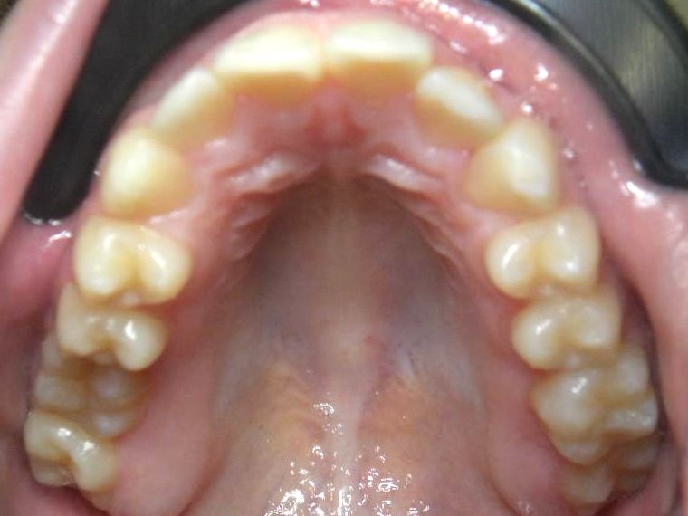 Oclusal Superior