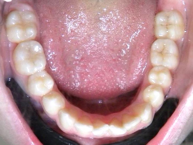 Oclusal Inferior