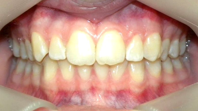 Frontal (Oclusión)