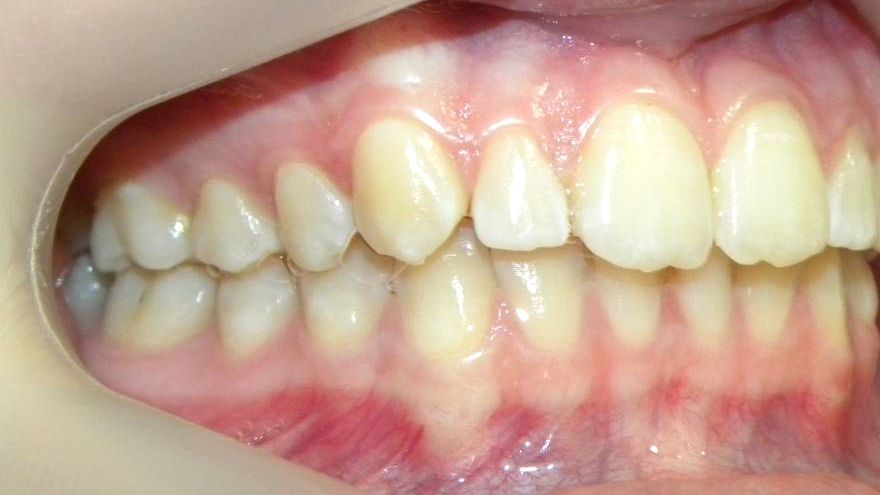 Lateral Derecha
