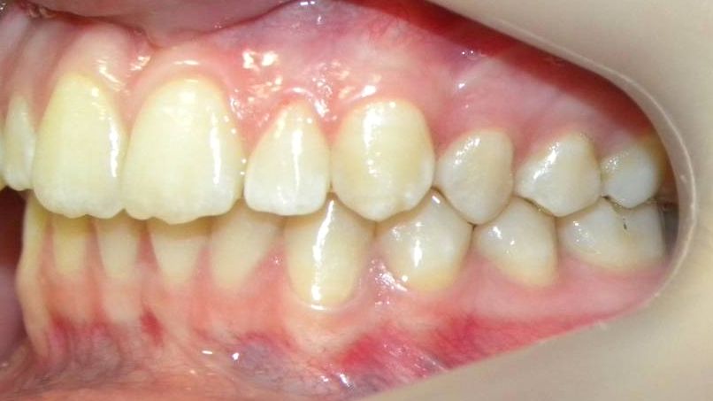 Lateral Izquierda