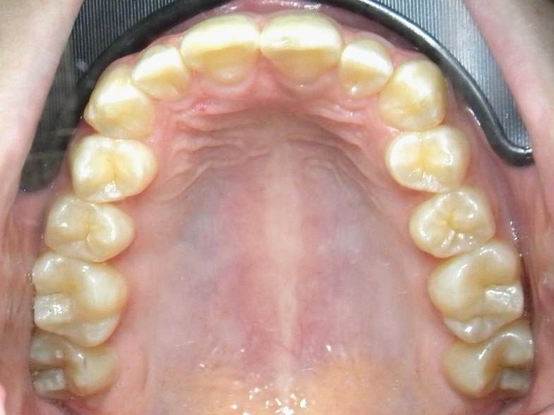 Oclusal Superior