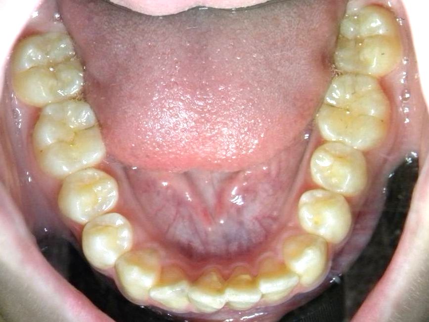 Oclusal Inferior