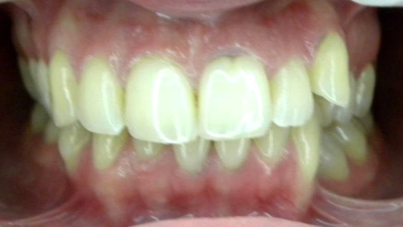Frontal (Oclusión)