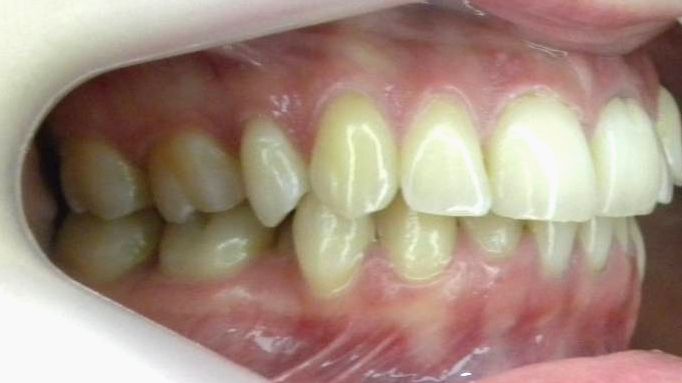 Lateral Derecha