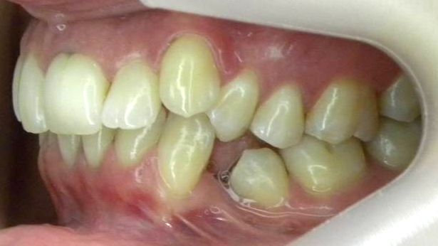 Lateral Izquierda