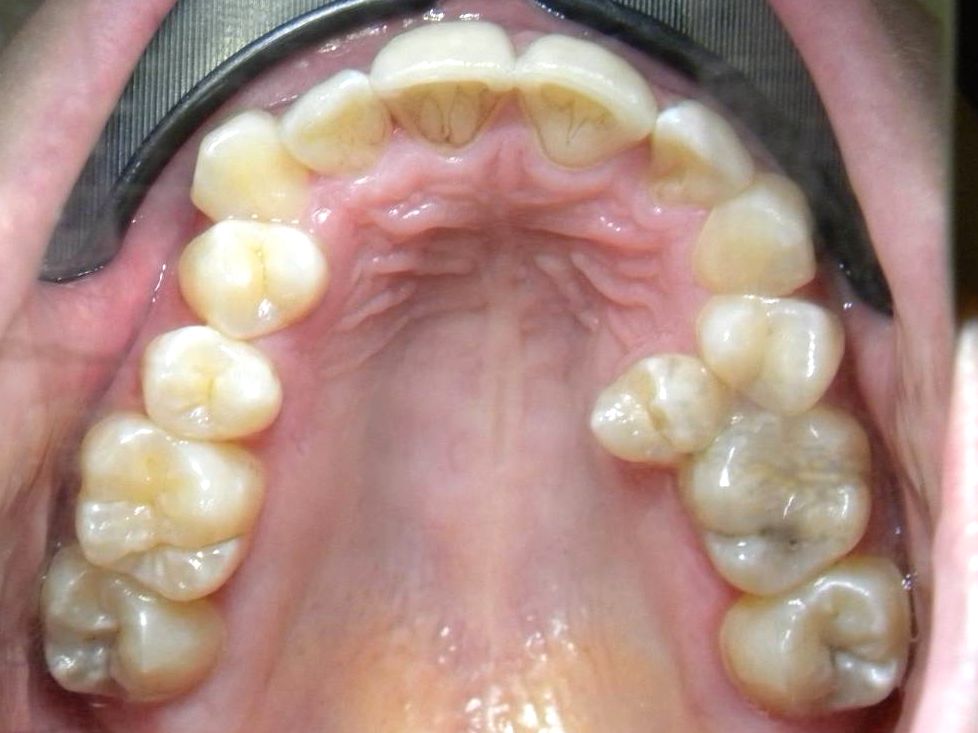 Oclusal Superior