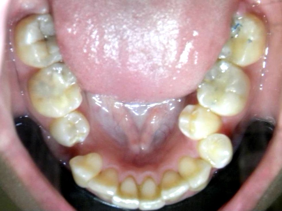 Oclusal Inferior